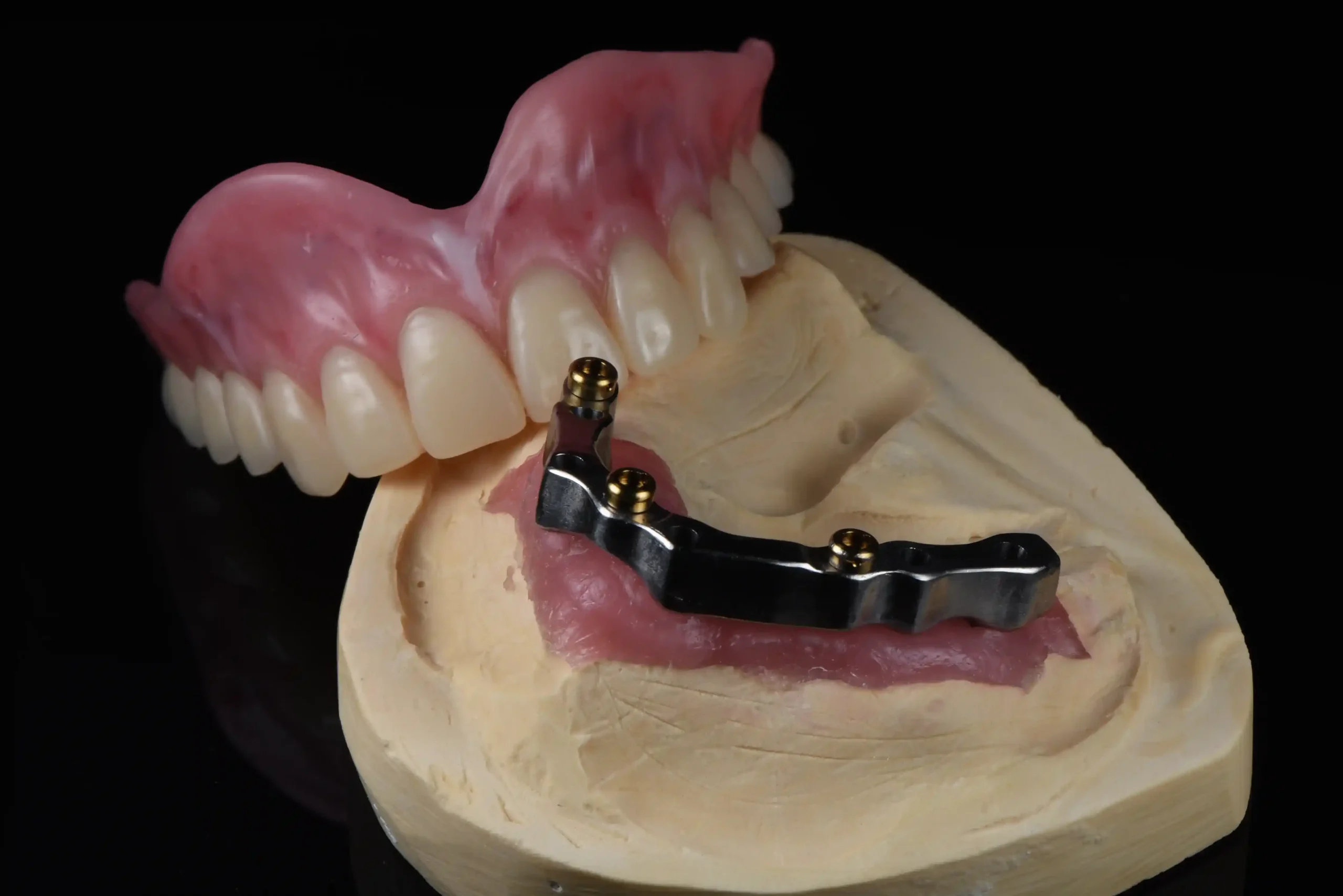 About Us 2 Implant-Supported Dentures (Fixed or Removable) Implant Denture Solutions