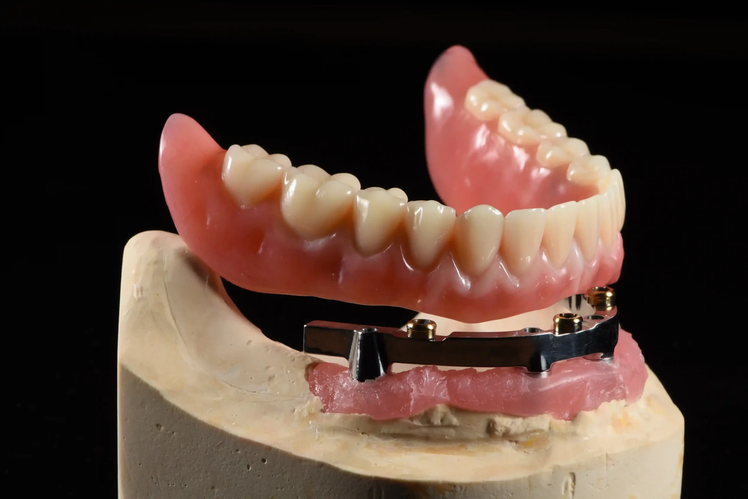 About Us 1 Implant-Supported Dentures (Fixed or Removable) Implant Denture Solutions