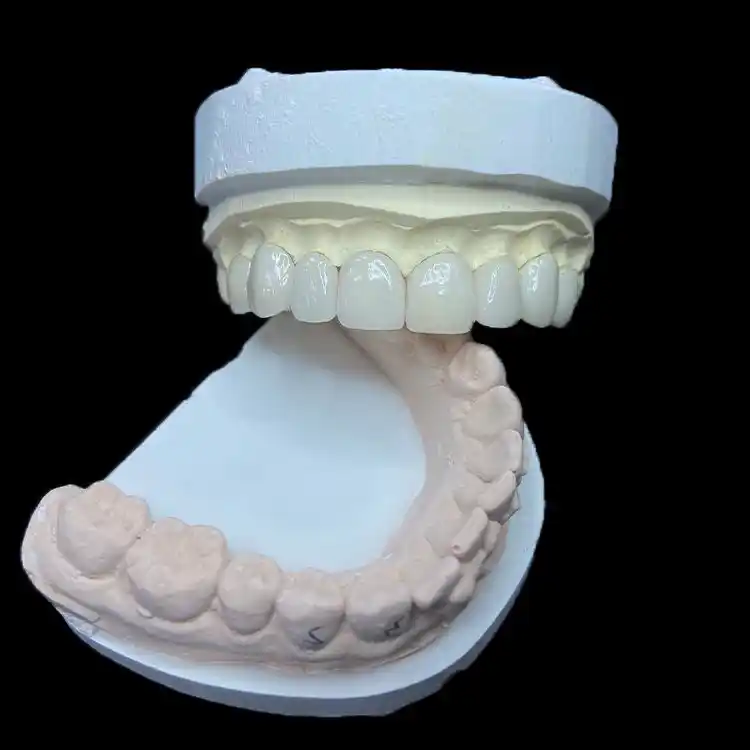 E.max Veneer vs Feldspathic Veneer Selection 2 E.max Veneer vs Feldspathic Veneer Selection