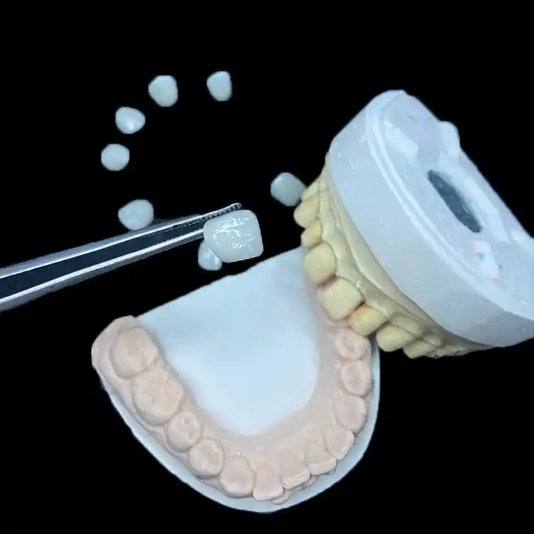 E.max Veneer vs Feldspathic Veneer Selection