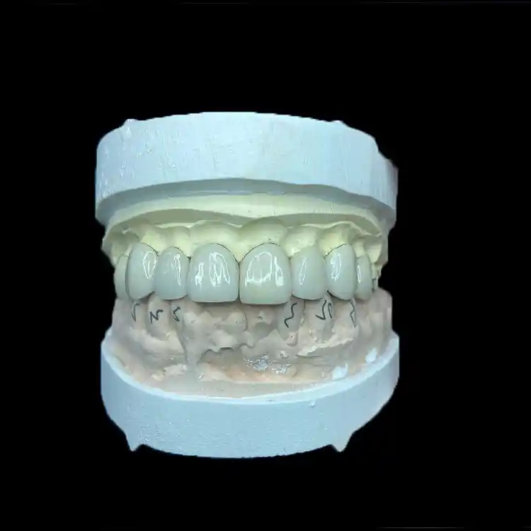E.max Veneer vs Feldspathic Veneer Selection 1 E.max Veneer vs Feldspathic Veneer Selection