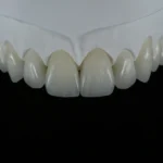 E.max Veneer