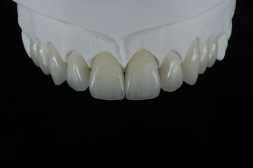 E.max Veneer