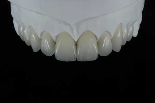 E.max Veneer