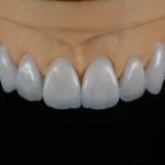 Feldspathic Veneer