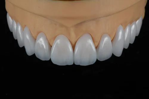 Feldspathic Veneer