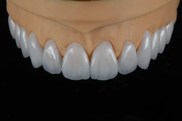 Feldspathic Veneer