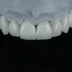 Full Contouring Multi-layer Zirconia