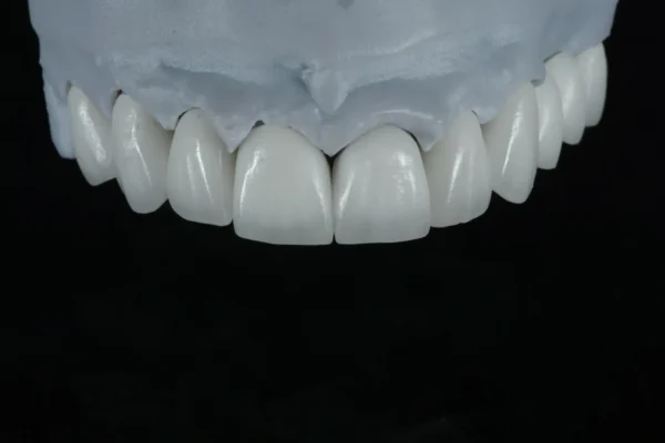 Full Contouring Multi-layer Zirconia