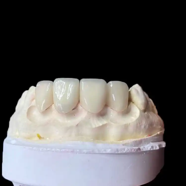 Full E.max Veneer (Monolithic): When Consistency Beats Layering 1 Full E.max Veneer (Monolithic) When Consistency Beats Layering