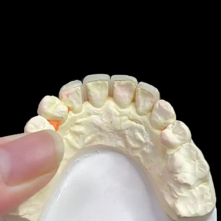 Full E.max Veneer (Monolithic): When Consistency Beats Layering 2 Full E.max Veneer (Monolithic) When Consistency Beats Layering
