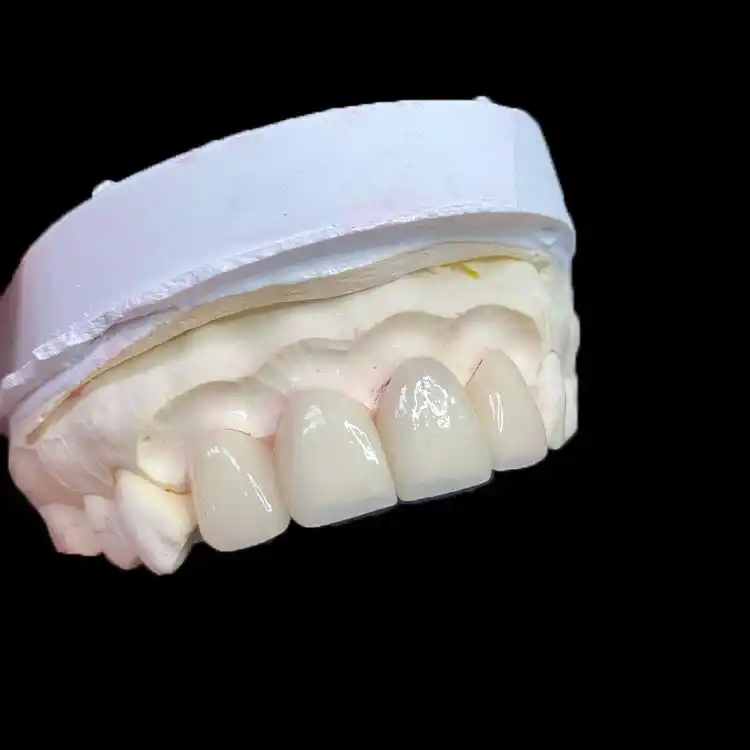 Full E.max Veneer (Monolithic): When Consistency Beats Layering 3 Full E.max Veneer (Monolithic) When Consistency Beats Layering