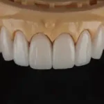 Full E.max Veneer Full E.max Veneer