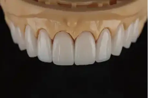 Full E.max Veneer
