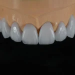 Layered E.max Veneer