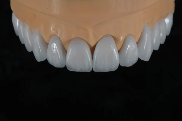 Layered E.max Veneer