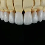 Layered Zirconia Crown