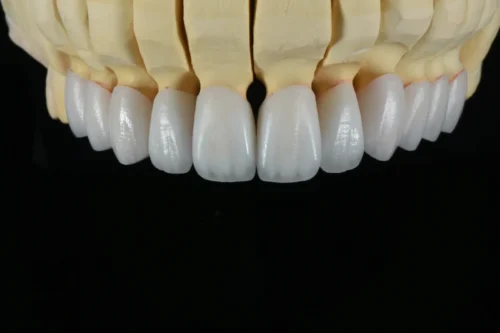 Layered Zirconia Crown