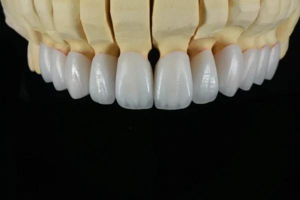 Layered Zirconia Crown