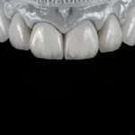 Zirconia veneer
