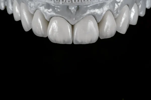 Zirconia veneer
