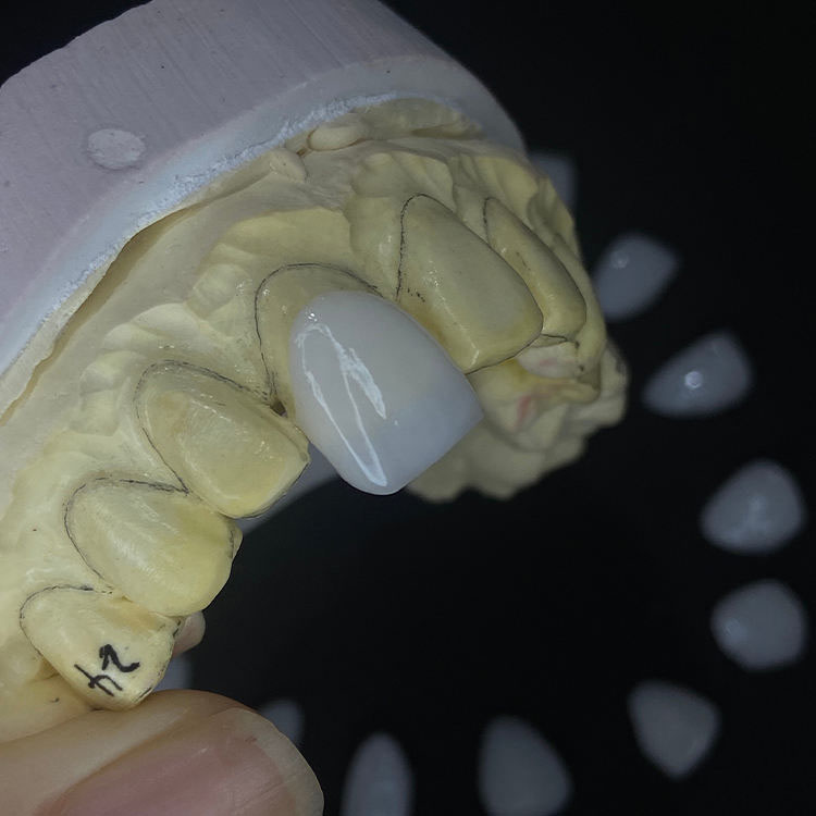 Full E.max Veneers vs Layered E.max Veneers: What Is the Real Difference? 1 Full E.max Veneers vs Layered E.max Veneers What Is the Real Difference