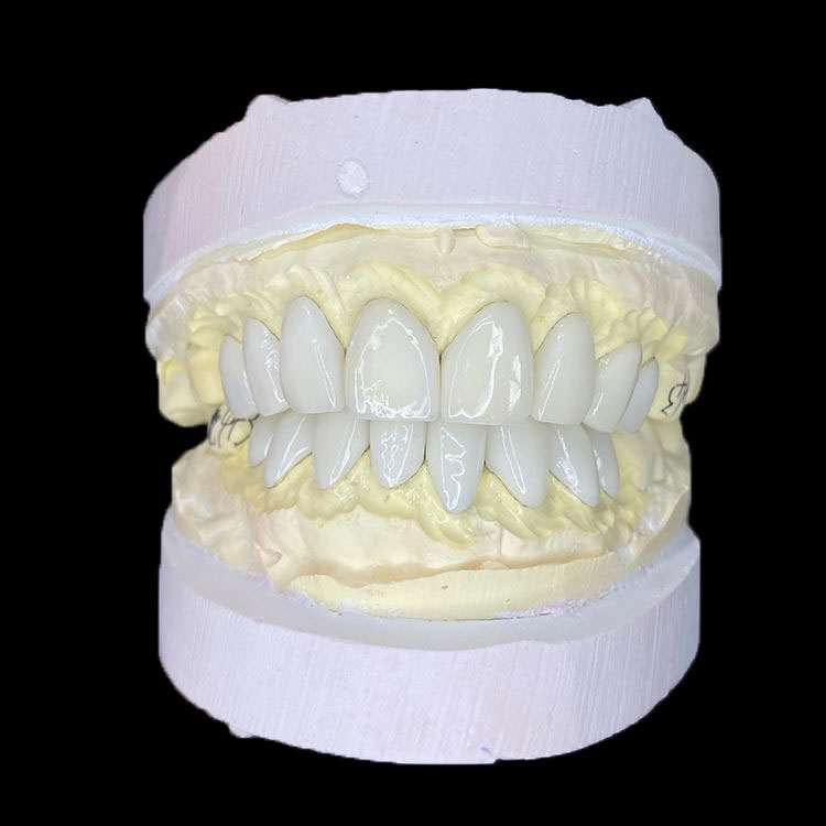 Full E.max Veneers vs Layered E.max Veneers: What Is the Real Difference? 2 Full E.max Veneers vs Layered E.max Veneers What Is the Real Difference