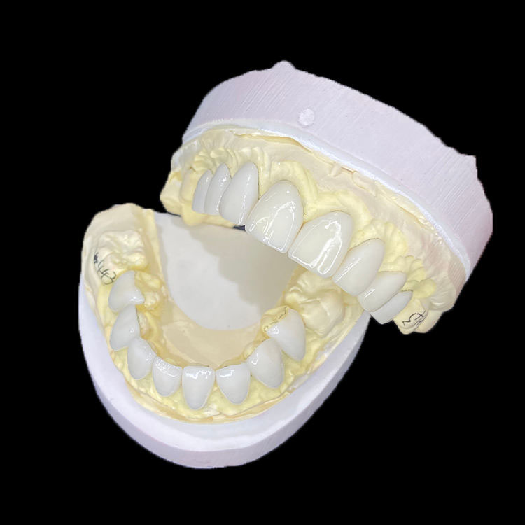 Full E.max Veneers vs Layered E.max Veneers: What Is the Real Difference? 3 Full E.max Veneers vs Layered E.max Veneers What Is the Real Difference