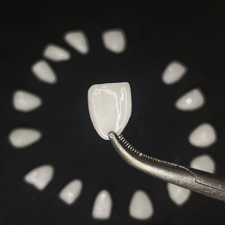 Full E.max Veneers vs Layered E.max Veneers What Is the Real Difference