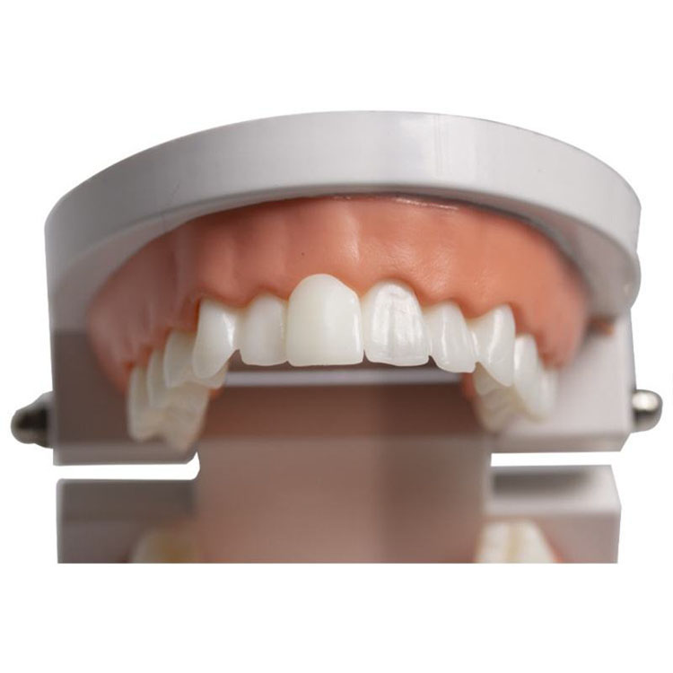 Can Layered E.max Veneers Truly Replace Feldspathic Veneers? 2 Can Layered E.max Veneers Truly Replace Feldspathic Veneers
