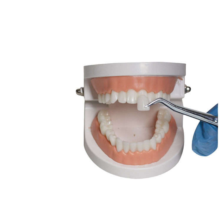 Can Layered E.max Veneers Truly Replace Feldspathic Veneers? 3 Can Layered E.max Veneers Truly Replace Feldspathic Veneers