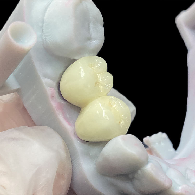 How to Reduce Chairside Adjustment for E.max Crowns 3 E.max Crowns