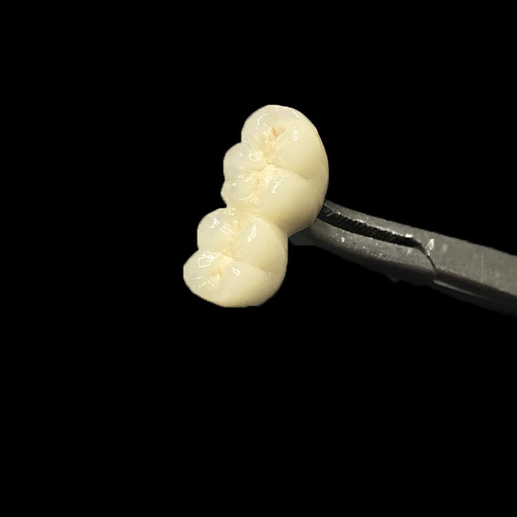 How to Reduce Chairside Adjustment for E.max Crowns 1 E.max Crowns