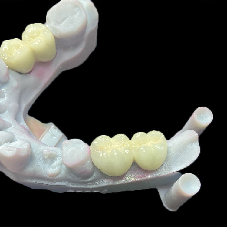 How to Reduce Chairside Adjustment for E.max Crowns 2 E.max Crowns
