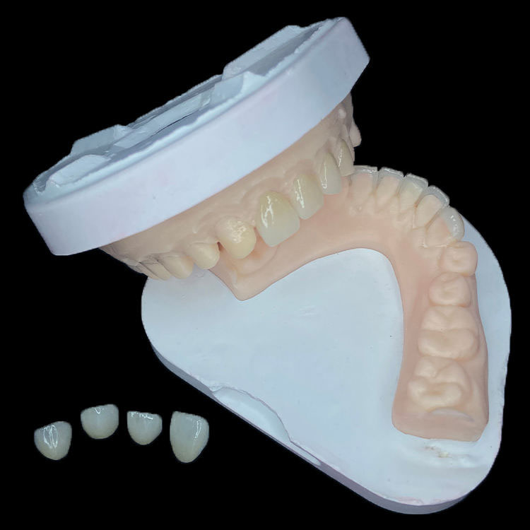 E.max Veneers