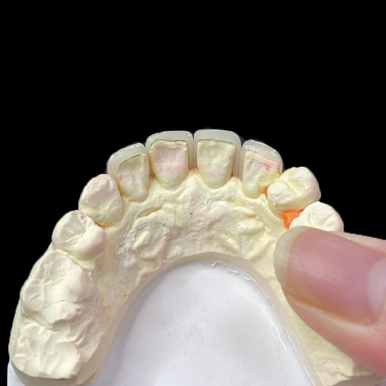 E.max Veneers