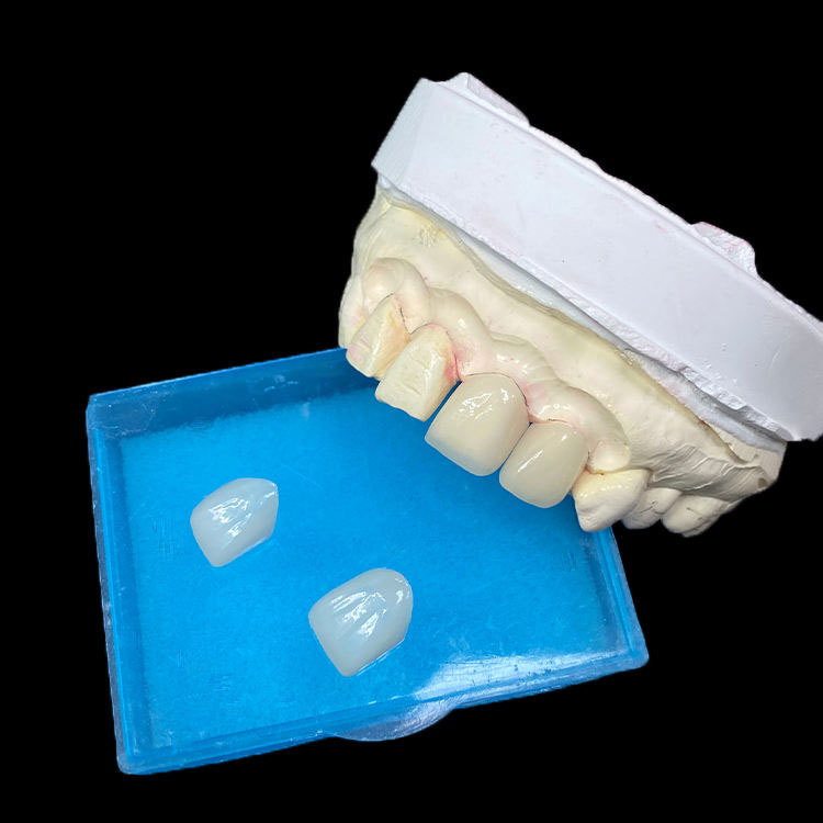 Quali tipi di cliniche dovrebbero posizionare le faccette Full E.max? 1 Faccette E.max