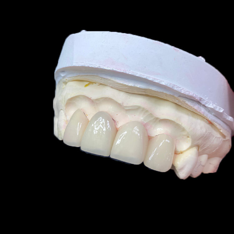 Quali tipi di cliniche dovrebbero posizionare le faccette Full E.max? 2 Faccette E.max