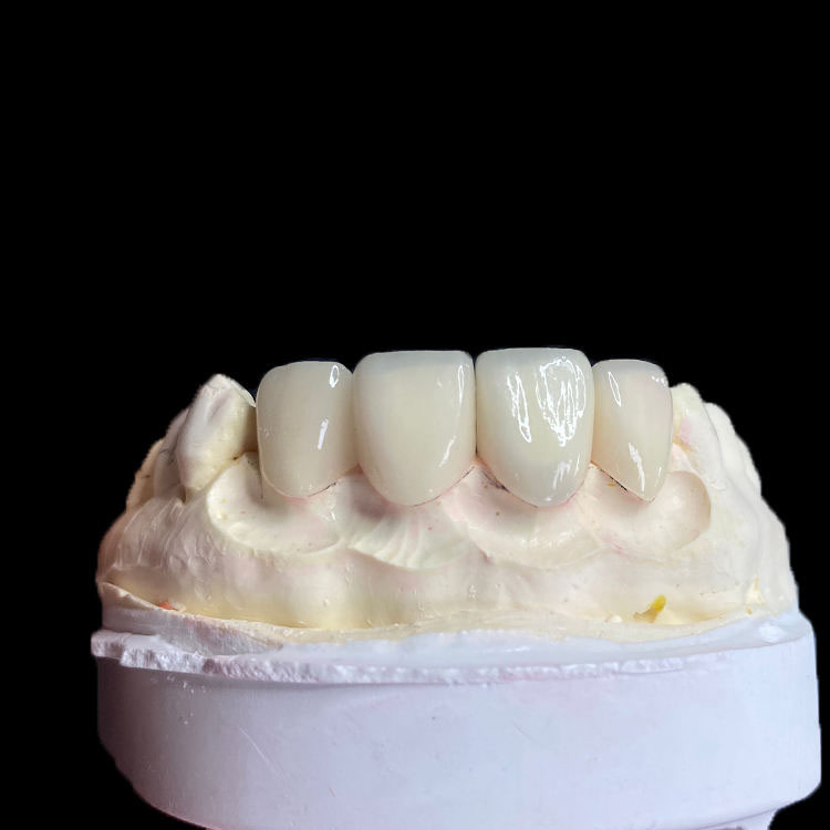 Quali tipi di cliniche dovrebbero posizionare le faccette Full E.max? 3 Faccette E.max