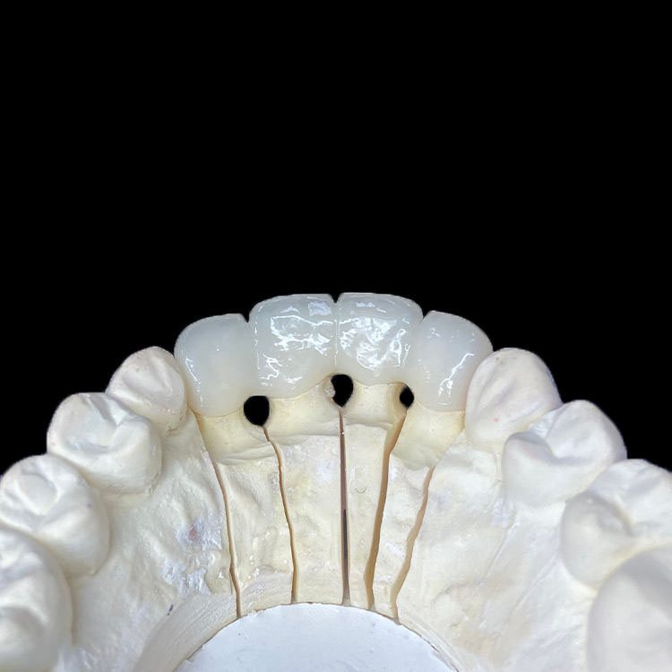 How Margin Design Differs Between Zirconia Crowns and E.max Crowns