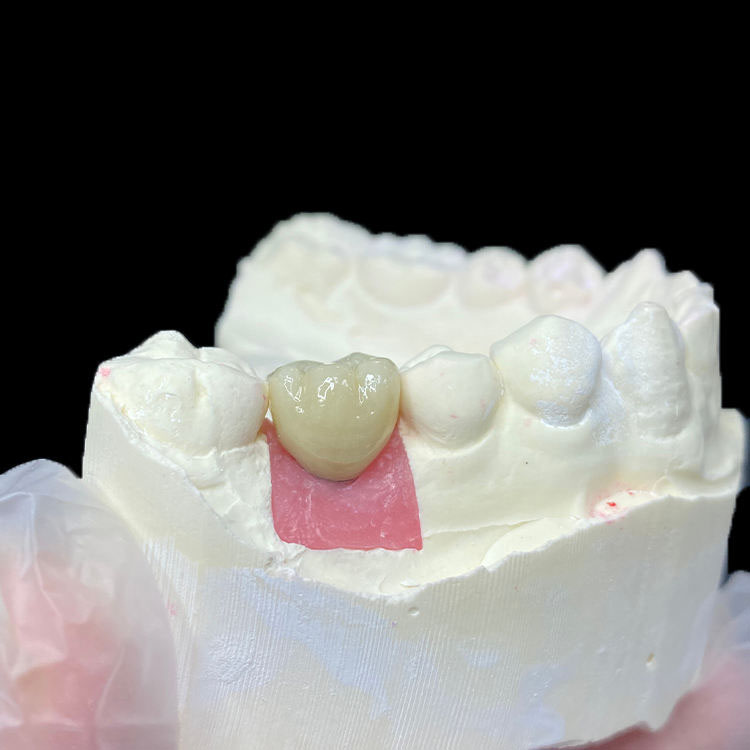 How Margin Design Differs Between Zirconia Crowns and E.max Crowns 1 How Margin Design Differs Between Zirconia Crowns and E.max Crowns