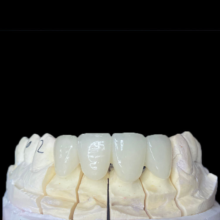 How Margin Design Differs Between Zirconia Crowns and E.max Crowns 2 How Margin Design Differs Between Zirconia Crowns and E.max Crowns