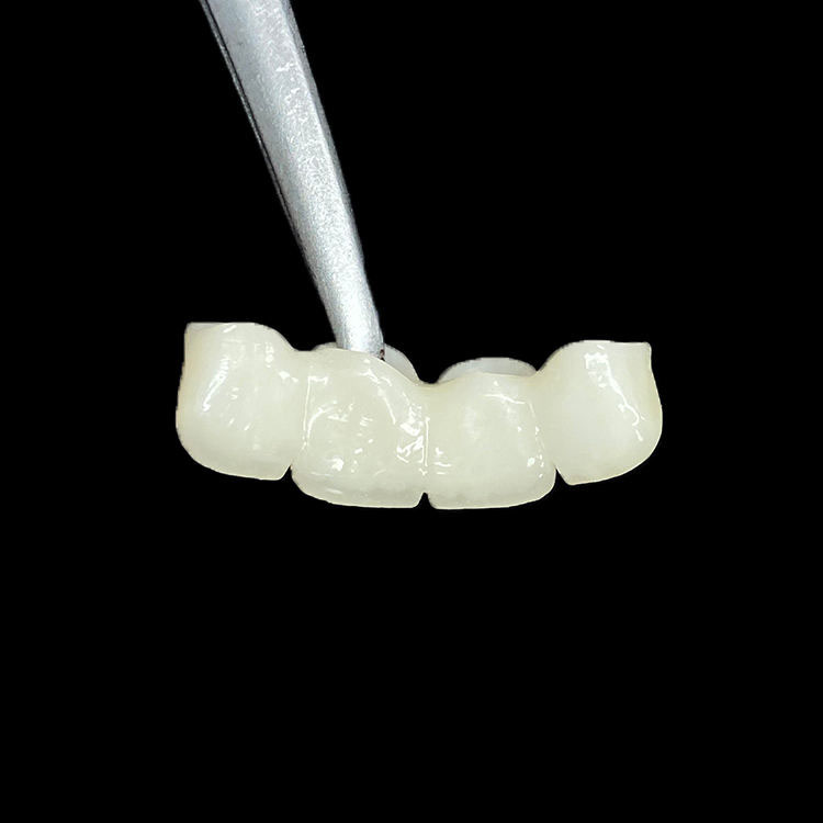 How Margin Design Differs Between Zirconia Crowns and E.max Crowns 3 How Margin Design Differs Between Zirconia Crowns and E.max Crowns