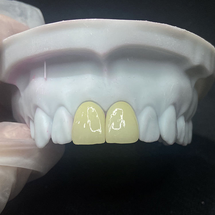 How Should Minimum Reduction for E.max Crowns Be Communicated to Buyers