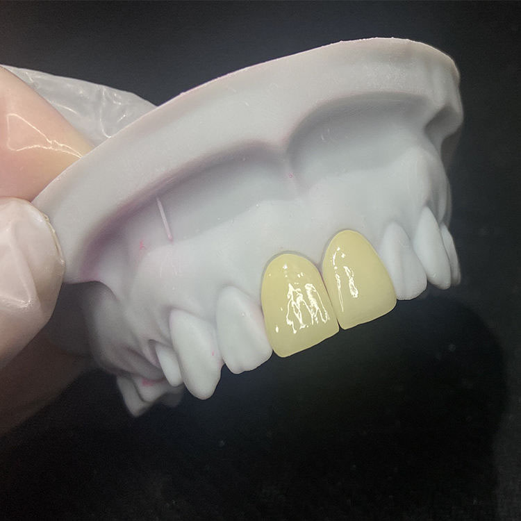 How Should Minimum Reduction for E.max Crowns Be Communicated to Buyers? 2 How Should Minimum Reduction for E.max Crowns Be Communicated to Buyers