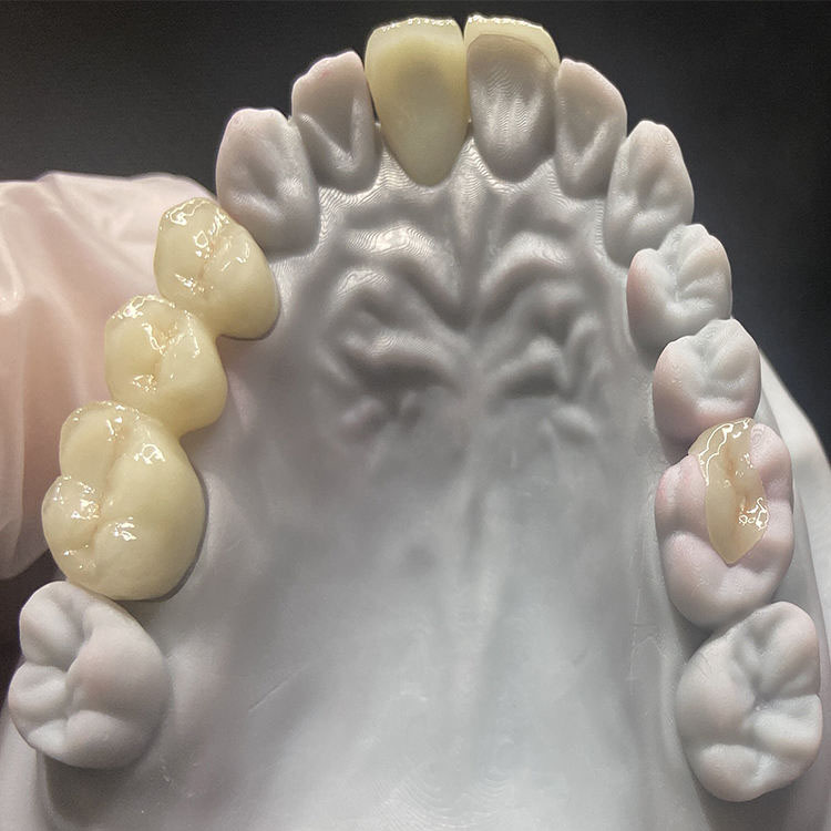 How Should Minimum Reduction for E.max Crowns Be Communicated to Buyers? 3 How Should Minimum Reduction for E.max Crowns Be Communicated to Buyers