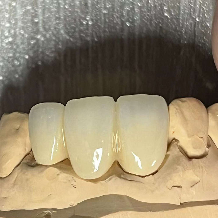 How Surface Treatment Differs Between E.max and Zirconia 2 How Surface Treatment Differs Between E.max and Zirconia