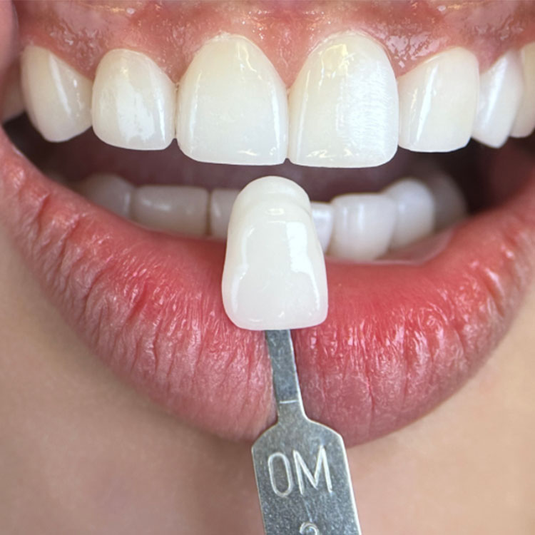 How Surface Treatment Differs Between E.max and Zirconia