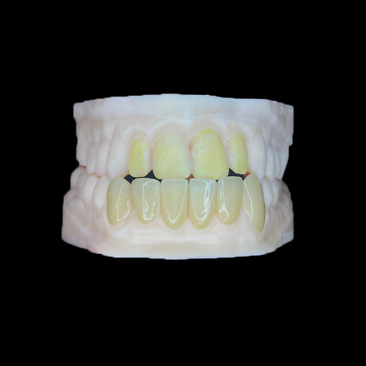 Como manter a linha média e a simetria em casos de facetas múltiplas 1 Multi-folheado