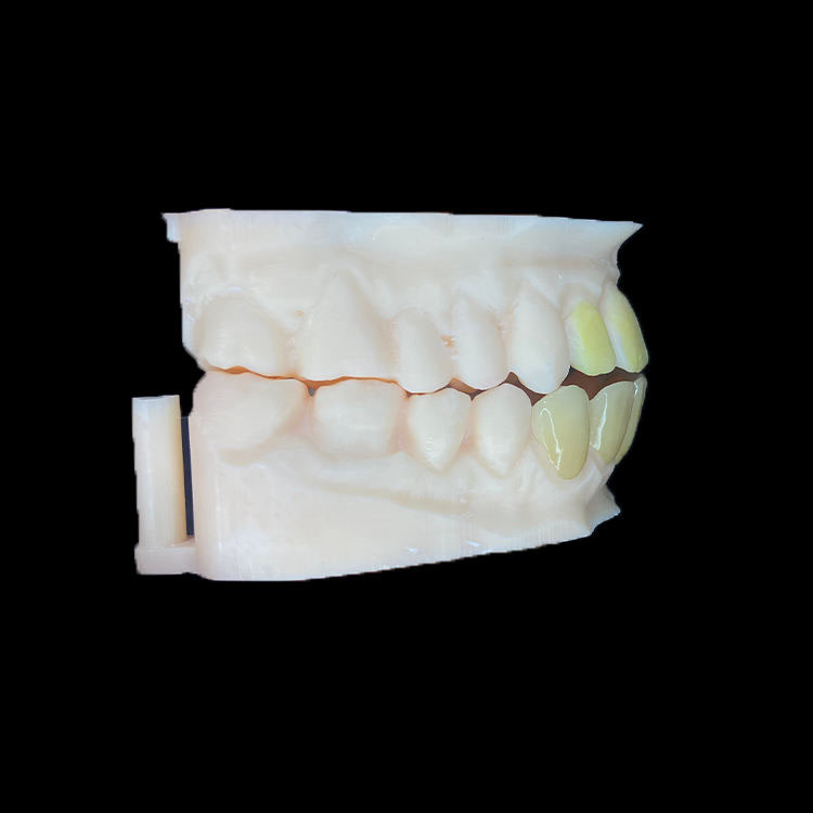 Como manter a linha média e a simetria em casos de facetas múltiplas 2 Multi-folheado